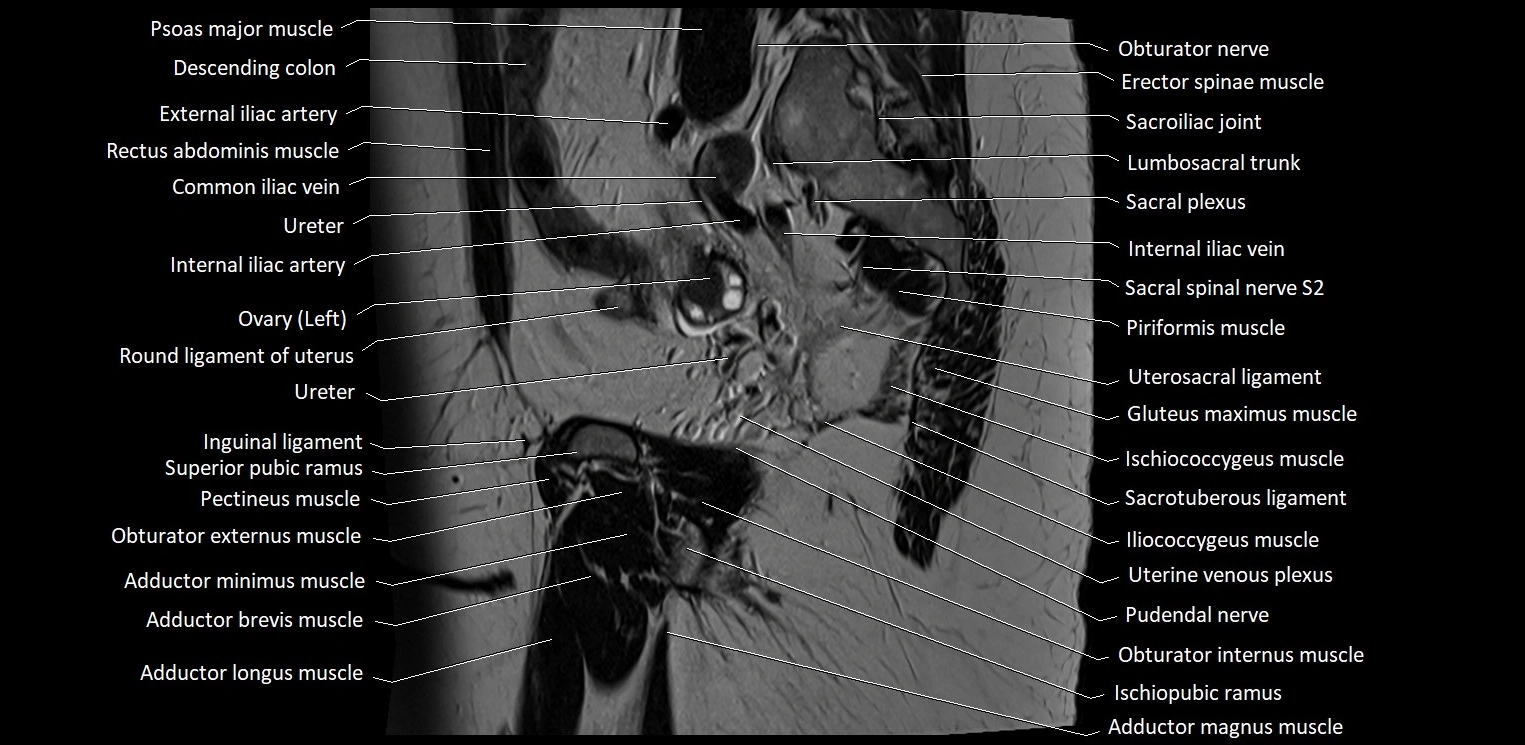 Sagittal cross sectional anatomy of female pelvis (MRI 3T) image 32.webp